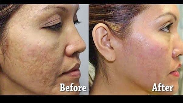 Acne: Before and After