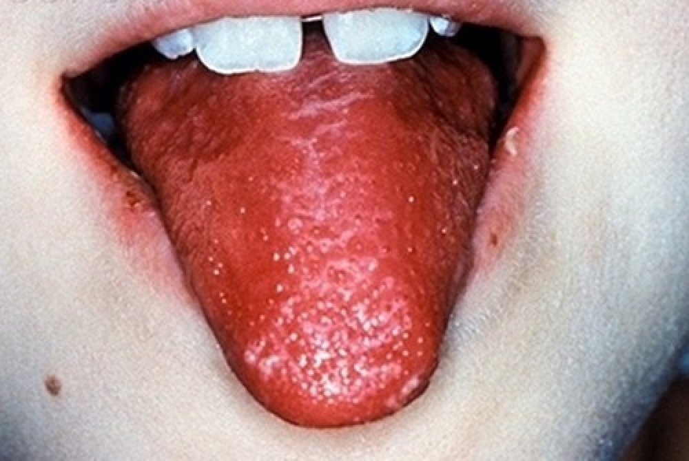 a red tongue