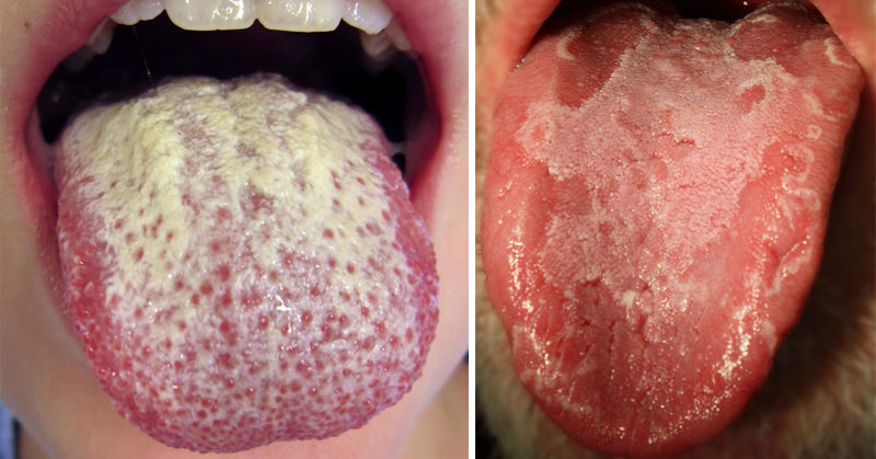 tongue with white patches