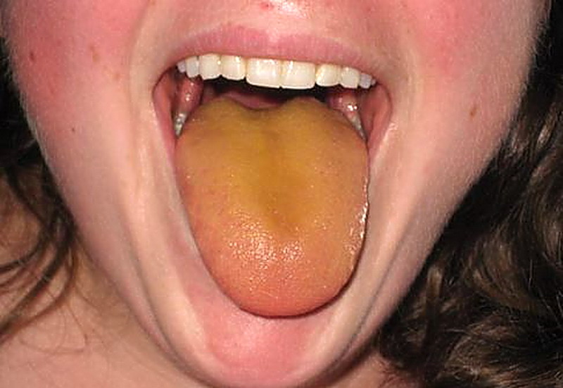 a yellow tongue