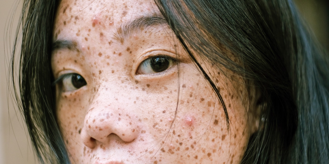 freckles