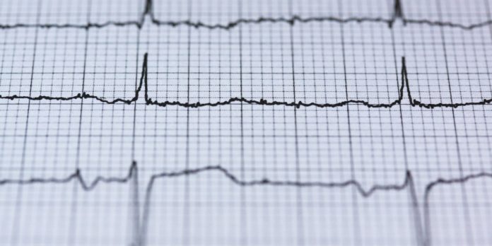 Tachycardia: Causes, Symptoms, Treatment